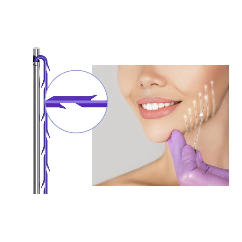 Molding Thread