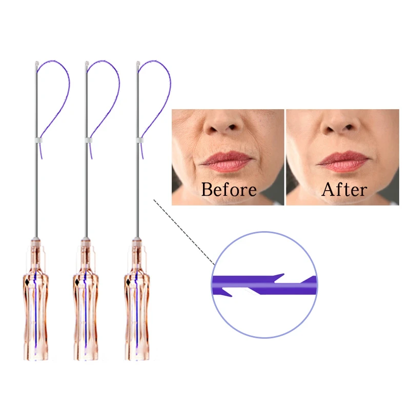 Molding Thread