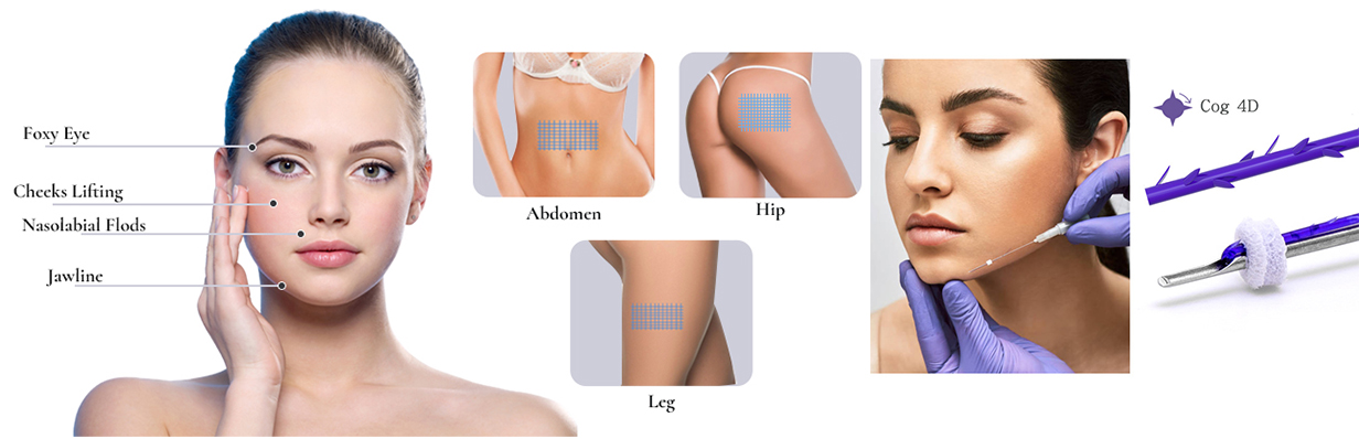 PDO Cog 4D Facial Lift: Advanced Thread Lifting for Jawline Contouring